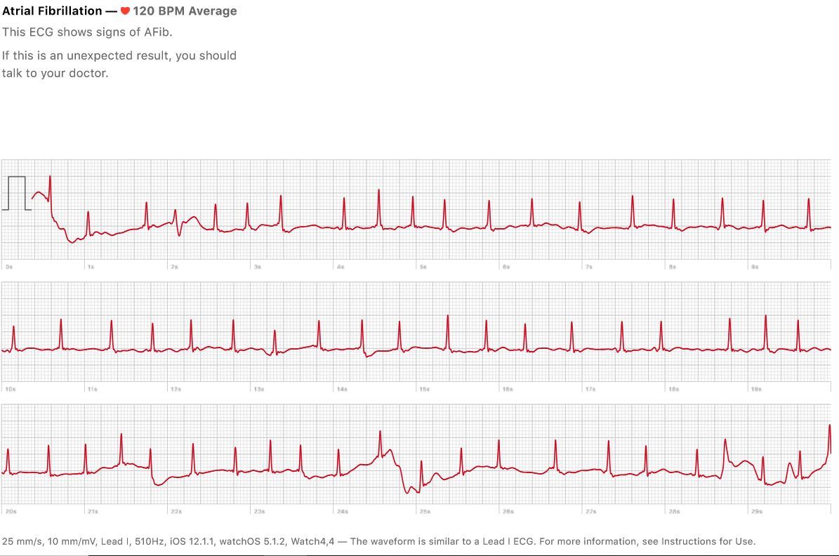 zapis z EKG w Apple Watchu