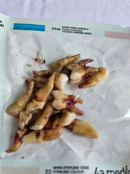 Brytyjka zrobiła sobie tureckie zęby