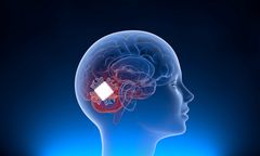 Firma Muska wszczepiła pierwszemu człowiekowi chip do mózgu