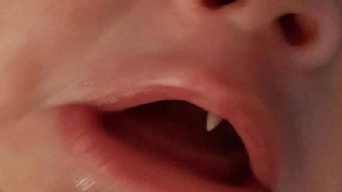 Matka twierdzi, że dziecku z dnia na dzień wyrósł dziwny kieł