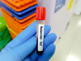 Test Western Blot – wskazania, przygotowanie, przebieg, cena 