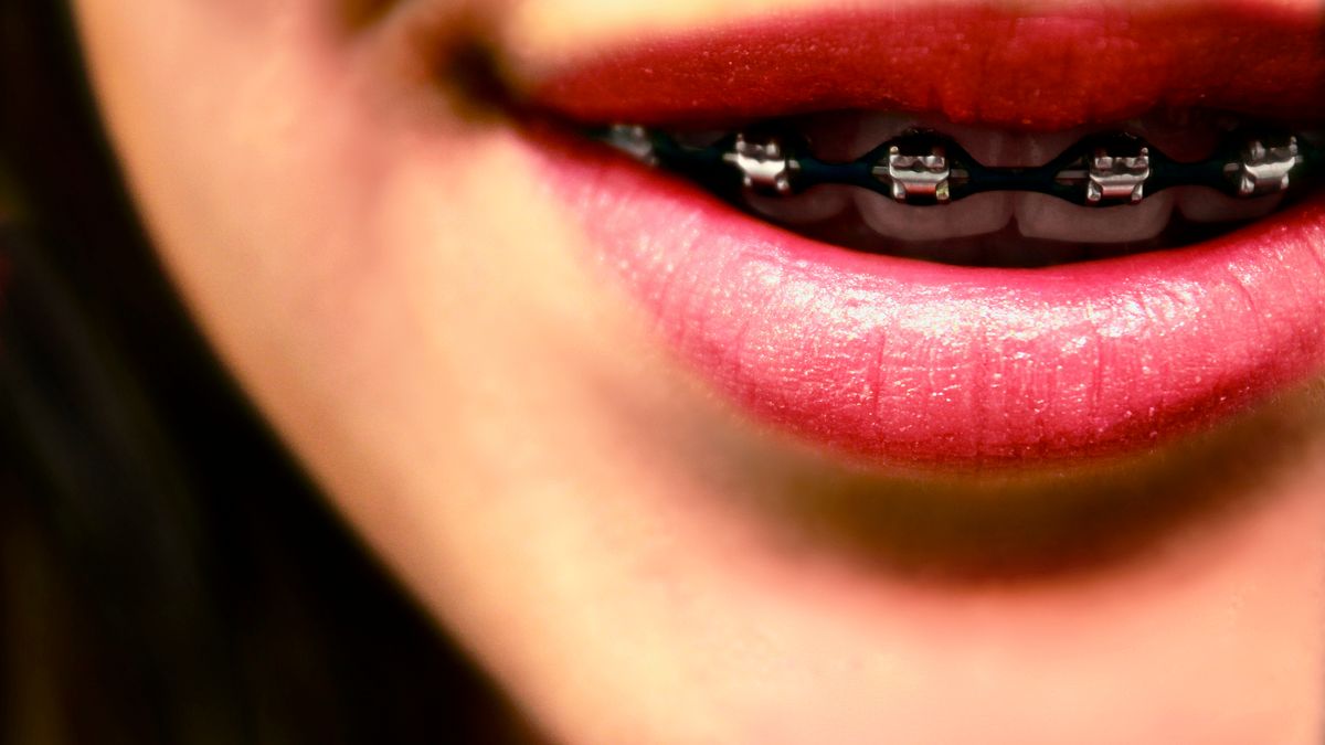 Jak dbać o zęby przy aparacie ortodontycznym?