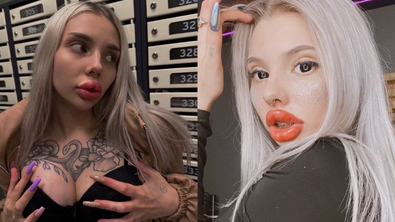 Beauty influencer's near-fatal experience with lip filler removal