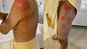 Jak po spotkaniu z niedźwiedziem grizzly! Michał Kwiatkowski pokazał obrażenia po wypadku