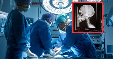 "Wielki skandal". 13-latka z Austrii miała nawiercić otwór w czaszce