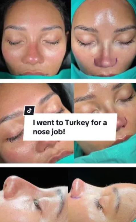 Jessica przeszła operację nosa w Turcji