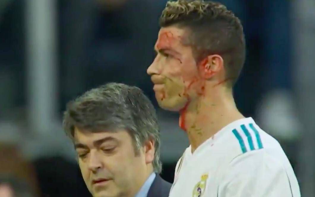 Ronaldo miał wypadek podczas ostatniego meczu