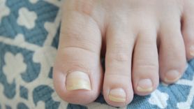 Żółte paznokcie dłoni i stóp - przyczyny, leczenie, profilaktyka