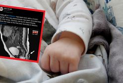 Szok na porodówce, noworodek urodził się z ogonem