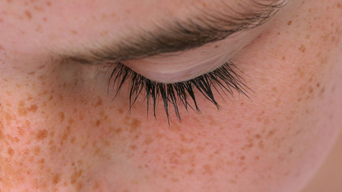 Ekspert przestrzega przed tiktokowymi metodami na pozbycie się piegów