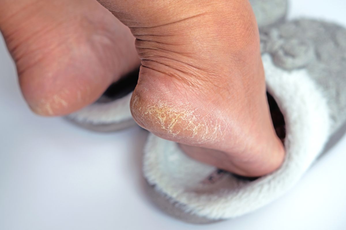 Solving dry heels: Glycolic acid for summer-ready feet