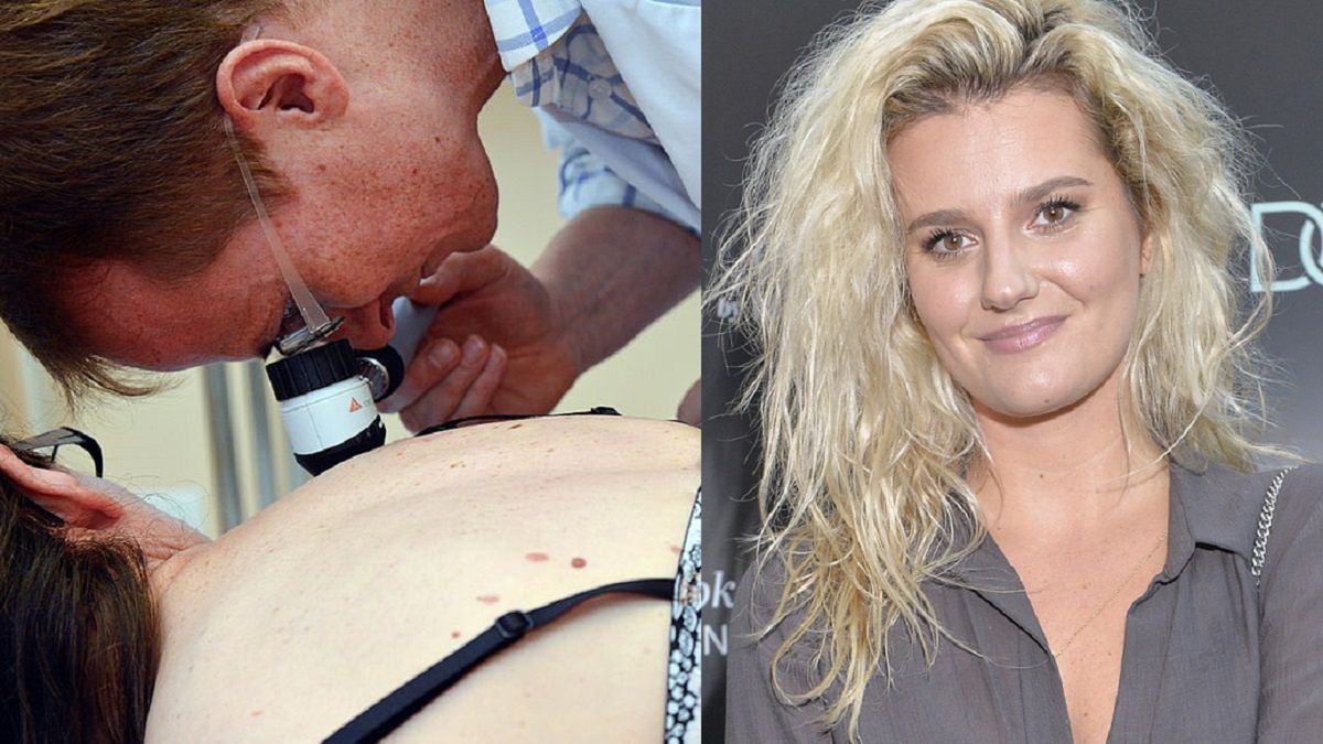 Zofia Zborowska miała czerniaka, nie lekceważ tych objawów