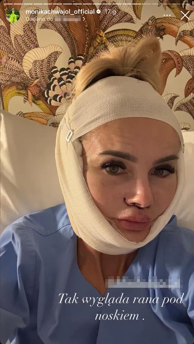Monika Chwajoł po liftingu i lip lifcie