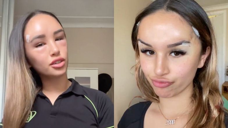 Tiktokerka chciała poprawić urodę. Po zabiegu żałowała decyzji 