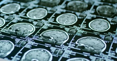 COVID-19 a objawy neurologiczne. Niepokojące analizy naukowców