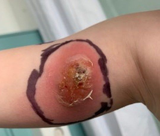 Otwarta rana po ukąszeniu owada