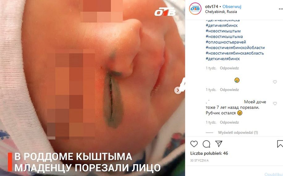 Dziewczynka miała ranę na policzku