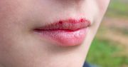 "Ukoi" spierzchnięte usta. Działa lepiej niż pomadka
