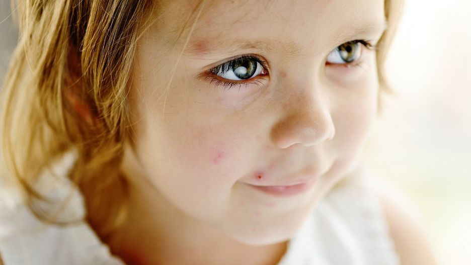 Dziewczynka z ospą wietrzną