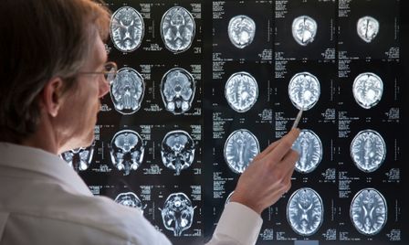 Służba zdrowia w Polsce. Neurolodzy narzekają na dostępność do terapii