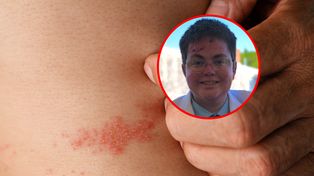 "Choroba motylich skrzydeł". Walczy o pomoc dla chorych na rzadkie schorzenie