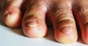 Szorstkie paznokcie. Ostrzeżenie, którego nigdy nie wolno lekceważyć