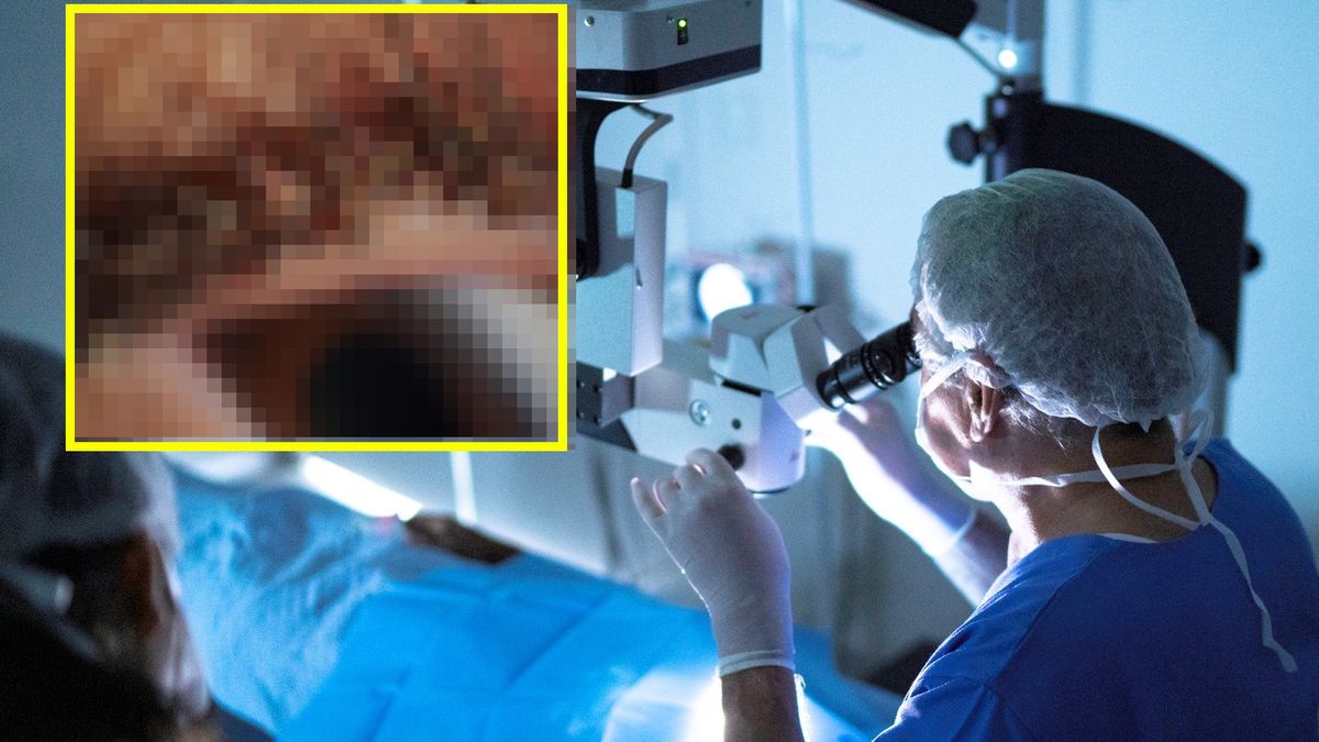 Kobieta miała na rzęsach setki gnid 