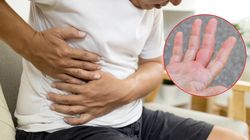 Objaw pojawia się na dłoniach. To znak, że wątroba przestaje działać