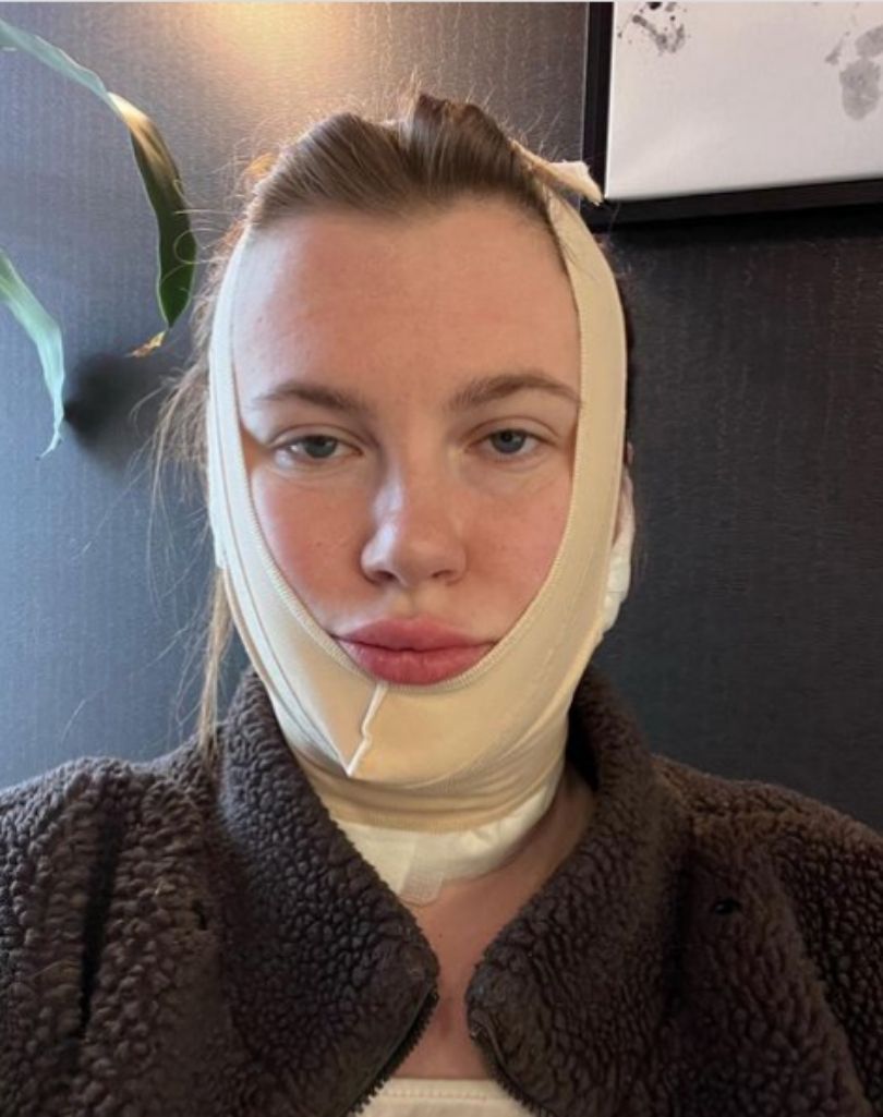Ireland Baldwin tłumaczy się z zabiegu podbródka
