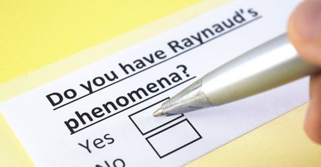 Objaw Raynauda - co to jest, jak powstaje i co oznacza? Choroba Raynauda i zespół Raynauda