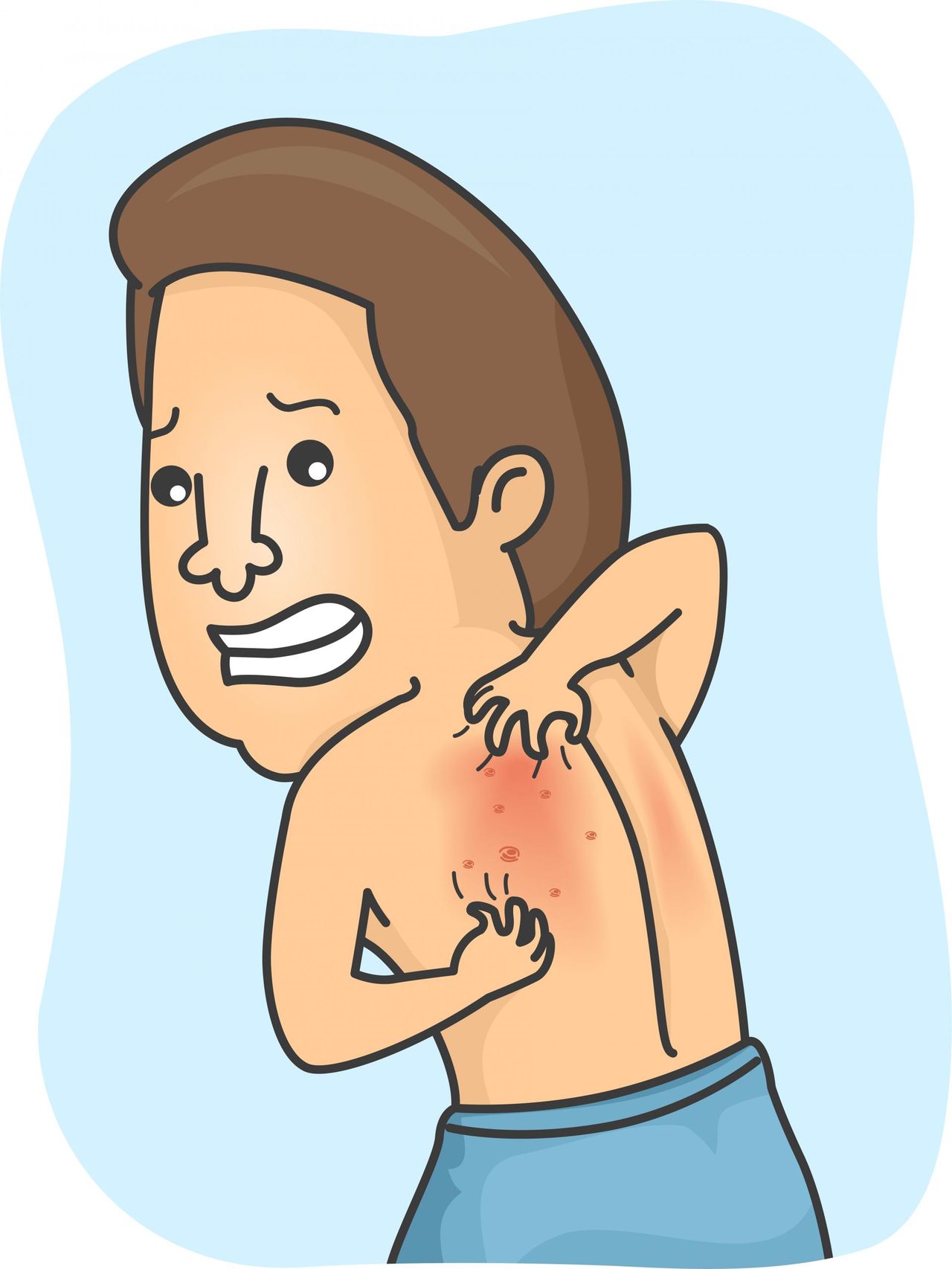 Swędząca skóra – czym jest swędzenie, przyczyny, alergie, leczenie, sposoby na świąd