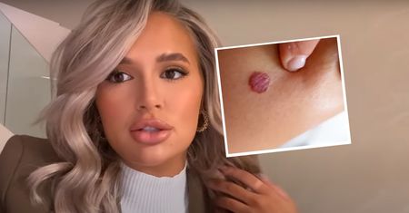 Usunęła pieprzyk i się zaczęło. Gwiazda "Love Island" jest przerażona