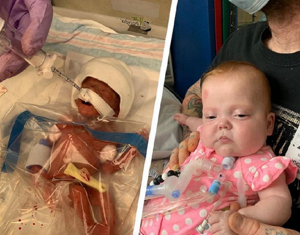 Urodziła w 22. tygodniu ciąży. Dziecko uratowano torebką na kanapki