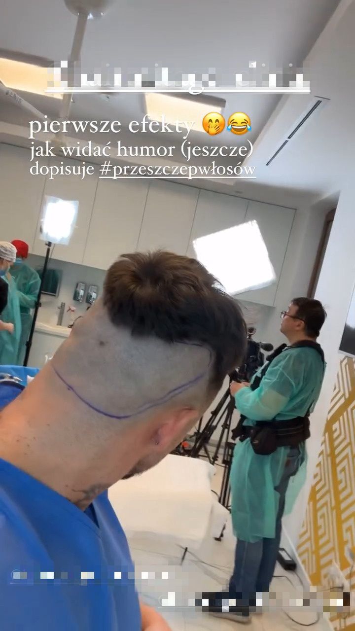 Qczaj zrelacjonował przeszczep włosów