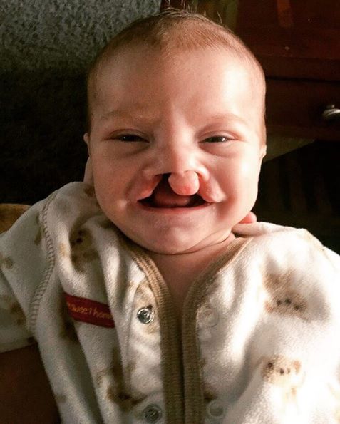 Rodzice uważają, że ich synek jest śliczny, mimo wrodzonej wady twarzy