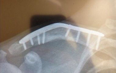 Zdjęcie rentgenowskie - metalowa płytka po wypadku w GP w Sztokholmie // źródło: Twitter