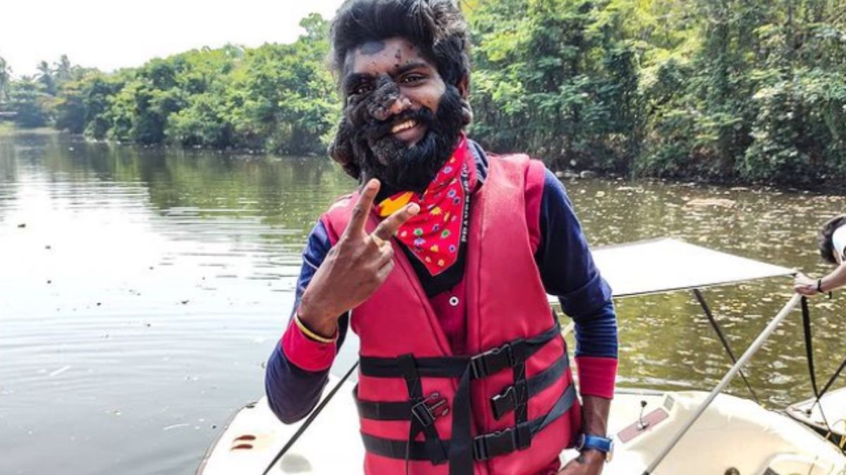 Twarz Prabhulala Prasannana jest w 80 procentach przykryta znamieniem