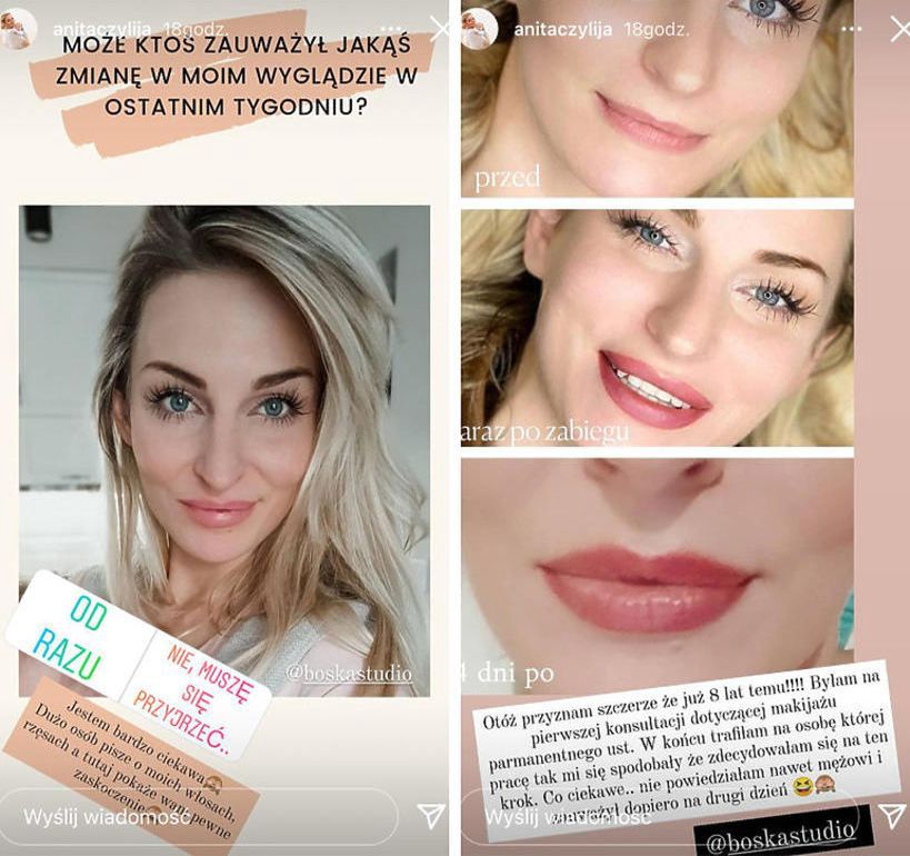 Anita ze "Ślubu od pierwszego wejrzenia" poprawiała urodę
