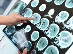 Poprawiają pamięć i koncentację. 6 produktów, które chronią przed chorobą Alzheimera