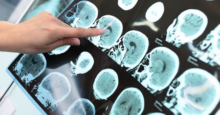 Poprawiają pamięć i koncentację. 6 produktów, które chronią przed chorobą Alzheimera