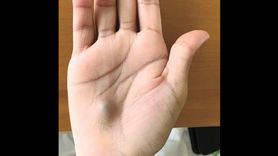 Dziwny guzek na dłoni okazał się objawem poważnej choroby