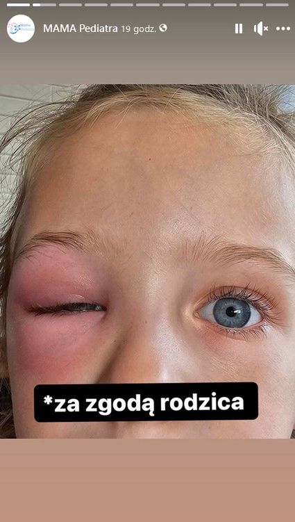 Dziecko po ukłuciu komara 