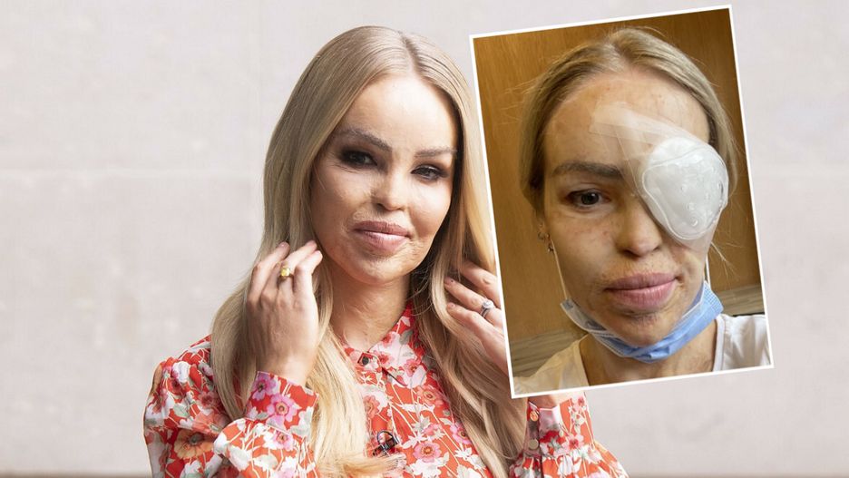Katie Piper jest już po kolejnej operacji