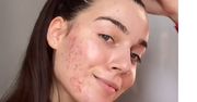 Tiktokerka nie wstydzi się pokazywać twarzy z trądzikiem. Promuje "acne positivity"