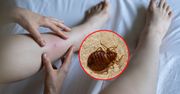 Są prawdziwą plagą w hotelach. Jak rozpoznać ugryzienia pluskwy?
