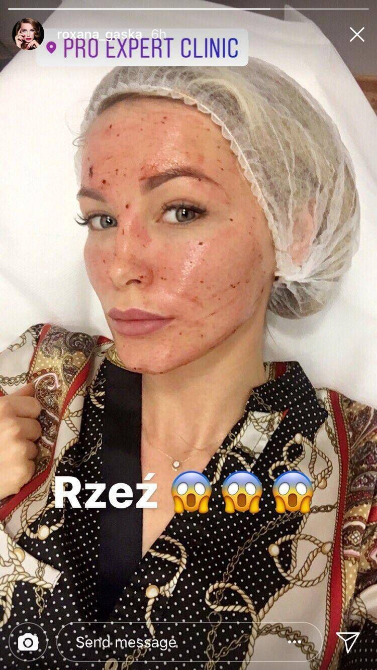 Roxi Gąska co sobie poprawiła?