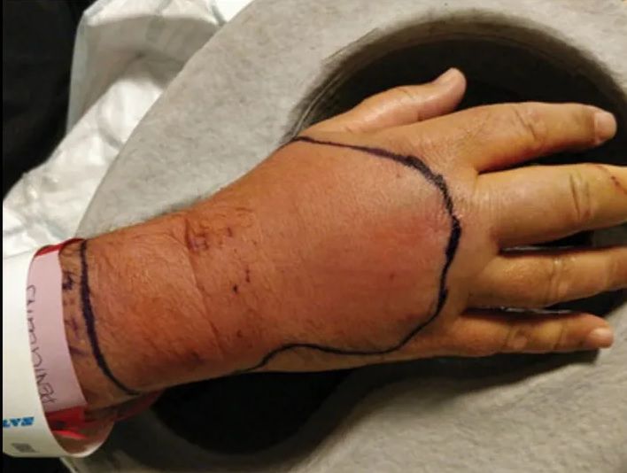 Nawet połowa pogryzień przez koty kończy się infekcją