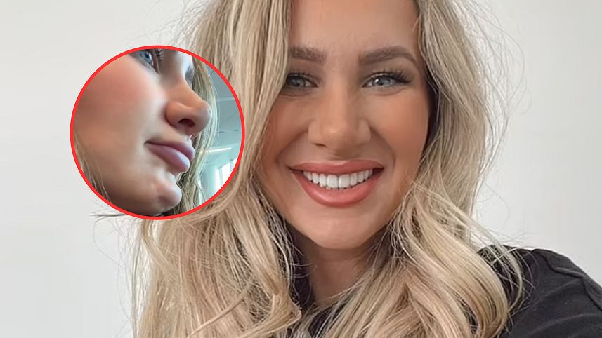 Po botoksie jej podbródek przybrał dziwny kształt. Zdruzgotana kobieta podzieliła się nagraniem