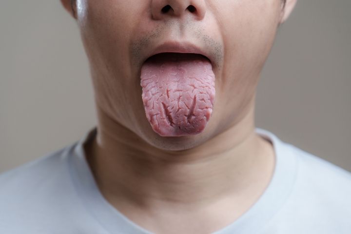 Język mosznowy jest najczęściej skutkiem niedoboru witamin w organizmie.