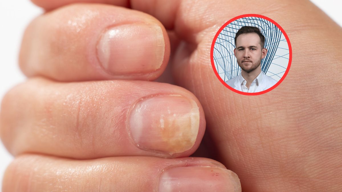 Rozwój grzybicy to nie zawsze kwestia higieny